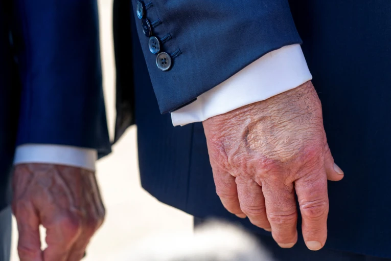 Με χρόνια φλεβική ανεπάρκεια διαγνώστηκε ο Αμερικανός πρόεδρος Ντόναλντ Τραμπ / Reuters