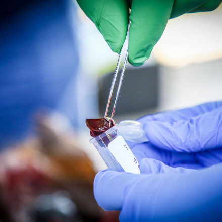 «Έξυπνα» φάρμακα με νανοσωματίδια ανοίγουν νέο δρόμο στη θεραπεία των ηπατικών παθήσεων