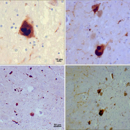 Ερευνητές βρήκαν την αιτία του Πάρκινσον ανοίγοντας δρόμο για νέες θεραπείες