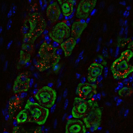 Ρινικό σπρέι κατά του καρκίνου του εγκεφάλου: Η πειραματική μέθοδος που αλλάζει τα δεδομένα