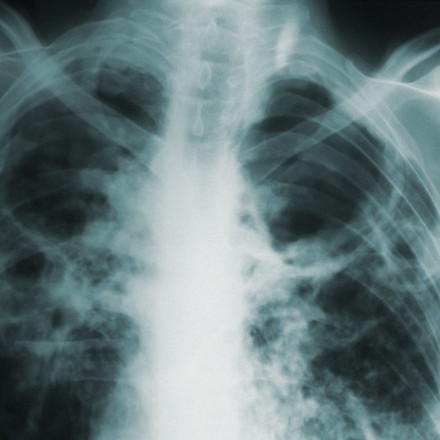 «Η ζωή με την άγνωστη – γνωστή νόσο»: Η Ιδιοπαθής Πνευμονική Ίνωση που χτυπά τους 50άρηδες