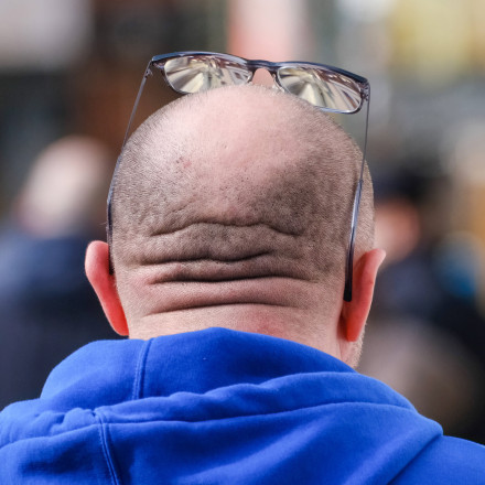 Φαλάκρα: Φυσικό τζελ ενεργοποιεί ξανά τους θύλακες των μαλλιών και παράγει νέες τρίχες