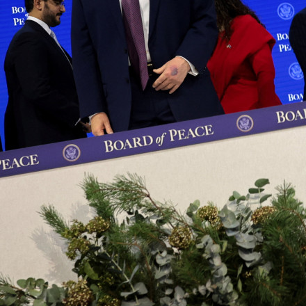 Ο Τραμπ απαντά για τη μελανιά στο χέρι του: Έπεσα πάνω στο τραπέζι και μεγάλωσε λόγω ασπιρίνης