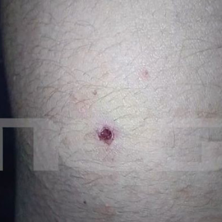 Αίγιο: Νέες φωτό από τα σκάγια που χτύπησαν τους ανήλικους - «Κυνηγός είναι, είδε το θήραμά του»