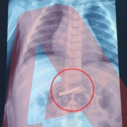 Τρίχρονο παιδί κατάπιε ξυραφάκι - Υποβλήθηκε σε χειρουργική επέμβαση