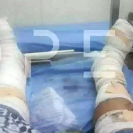 Σουδάν: Φωτογραφία-ντοκουμέντο με τα τραύματα του Έλληνα που χτυπήθηκε από ρουκέτα - Οι γιατροί δεν μπορούν να φτάσουν στο νοσοκομείο