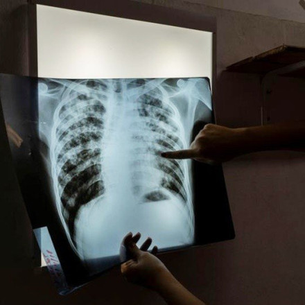 Καλπάζει η φυματίωση στην Ελλάδα - Αυξημένα κατά 54% τα δηλωμένα περιστατικά το 2023