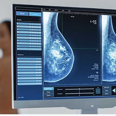 Μαστογραφία: Νεότερες εξελίξεις στις κατευθυντήριες οδηγίες