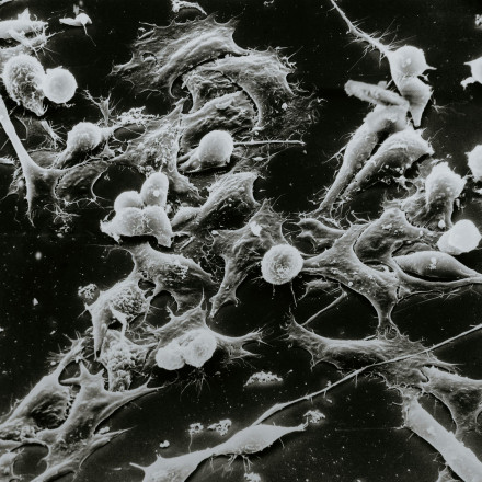 Υψηλότερος κίνδυνος εμφάνισης 17 μορφών καρκίνου για Generation X και millennials Υψηλότερος κίνδυνος εμφάνισης 17 μορφών καρκίνου για Generation X και millennials