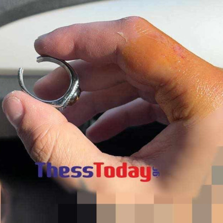 Χαλκιδική: Πήγε στο νοσοκομείο για να του αφαιρέσουν δαχτυλίδι και οι γιατροί φώναξαν... ηλεκτρολόγο