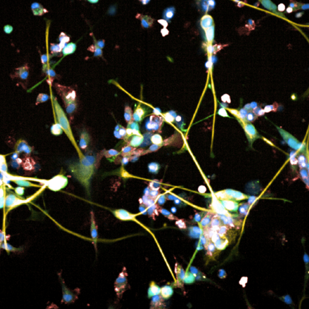 Καρκίνος στον εγκέφαλο: Αντικαταθλιπτικό γεννά ελπίδες για τη θεραπεία των όγκων