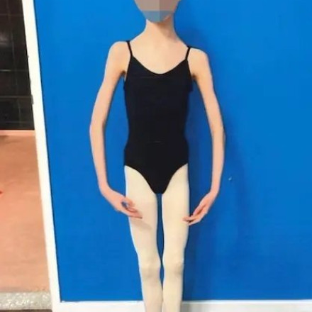 Μπαλαρίνα 17 ετών ζύγιζε μόλις 27 κιλά... Βαριά ποινή στους γονείς της - Καταπέλτης η δικαστής