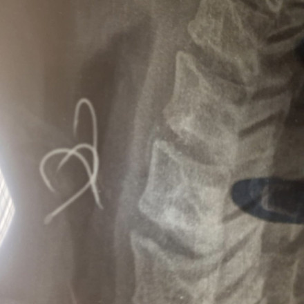 Αγρίνιο: «Έγινα μπλε, μου κόπηκε η ανάσα», λέει ο 38χρονος που κατάπιε αγκίστρια από χταπόδι