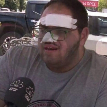 Κρήτη: Παρέμβαση ΣΕΠΕ και Άδωνι Γεωργιάδη για τον ανασφάλιστο εγκαυματία εργαζόμενο