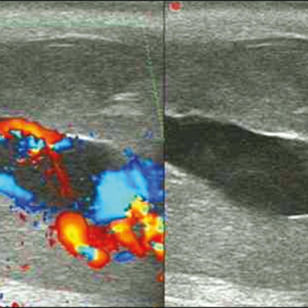 Τατουάζ στο πέος άφησε νέο άνδρα με μόνιμη ημιστύση - Γιατί διάλεξε να ζήσει με πριαπισμό