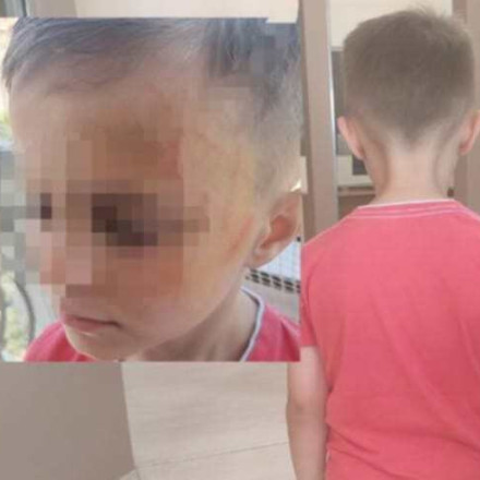 Σοκαριστική καταγγελία στο Αγρίνιο: 5χρονος ξυλοκοπήθηκε άγρια από συμμαθητές του σε νηπιαγωγείο