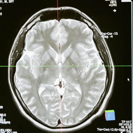 Πόσο γρήγορα γερνάει ο εγκέφαλός σου - Μια μαγνητική θα στο δείξει