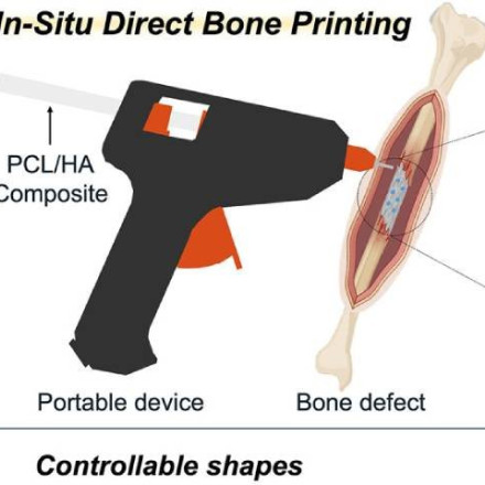 Καινοτόμο «πιστόλι» τρισδιάστατης εκτύπωσης δημιουργεί οστικά μοσχεύματα επί τόπου