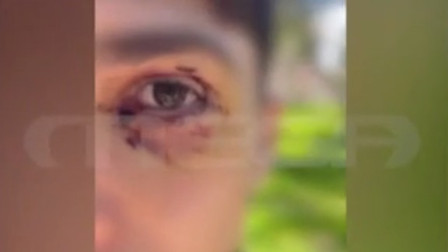 Με μόνιμη βλάβη στο μάτι ο 16χρονος που ξυλοκοπήθηκε από ανήλικους στα Ιωάννινα