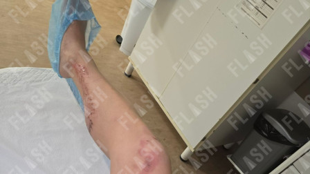 Επεισοδιακή καταδίωξη: Έμπορος ναρκωτικών πάτησε αστυνομικό με το αυτοκίνητο για να μην συλληφθεί