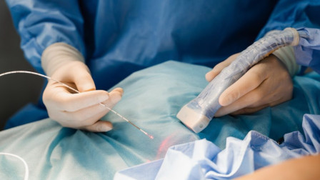 Κιρσοί: Μια ύπουλη νόσος που επηρεάζει την καθημερινότητα - Τι πρέπει να γνωρίζεις