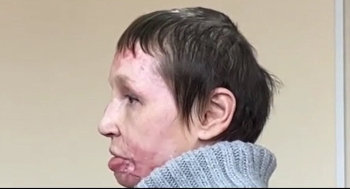 Φρίκη στη Ρωσία: «Σταύρωσε» και έβαλε φωτιά στη σύντροφό του - «Με άναψε σαν κερί...»